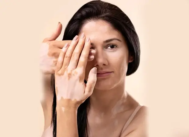 Best Vitiligo Treatment in South Delhi