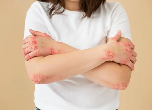 Psoriasis