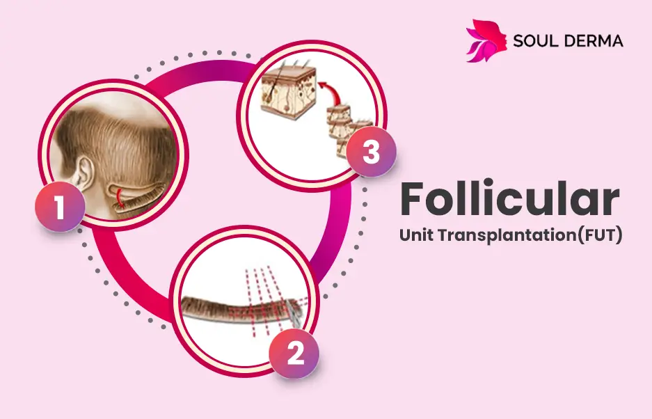 Follicular Unit Transplantaion