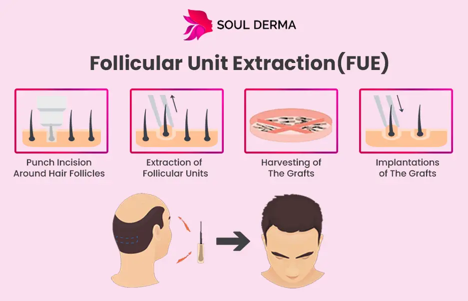 Follicular Unit Extraction