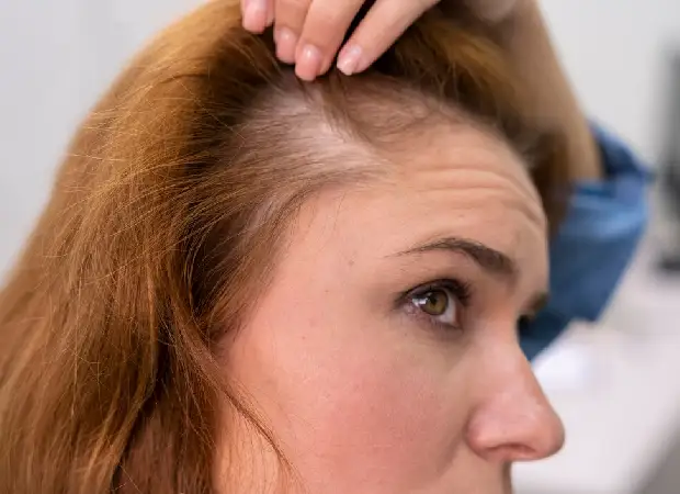 What is  mesotherapy for hair?